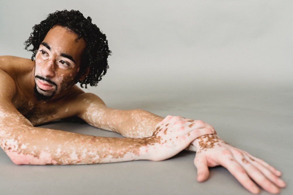 piel sensible con vitiligo
